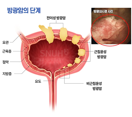 About bladder cancer