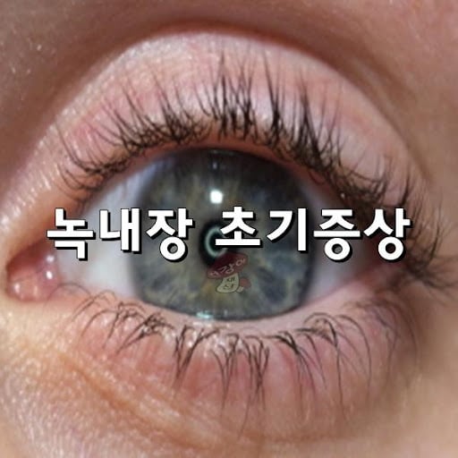 녹내장 초기증상