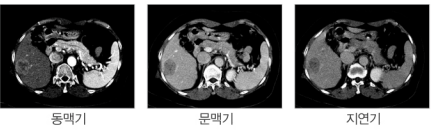 간암 진행상황에 따른 CT촬영 사진