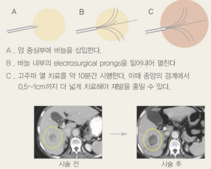 고주파 열치료 방법(출처: 서울아산병원 암교육정보센터)