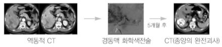 경동맥 화학색전술의 CT사진(출처: 서울아산병원 암교육정보센터)