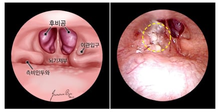 정상 비인두의 내시경소견과 비인두암